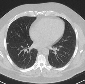 Chest CT scan